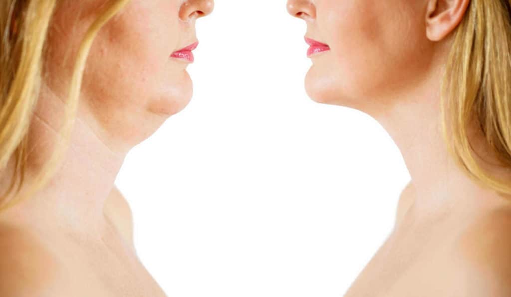Double Chin treatment Lowestoft before and after results
