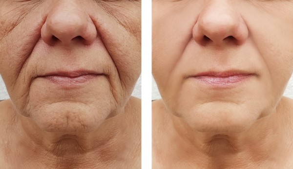 Learn more about Morpheus8 Treatment Lowestoft today!