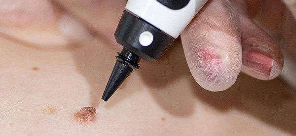 After Skin Tag Removal Lowestoft