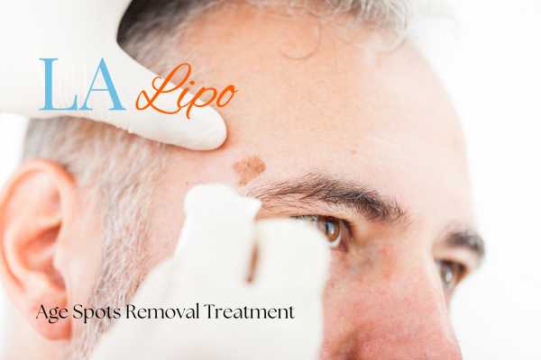 What Are the Most Effective Treatments for Age Spots Lowestoft?