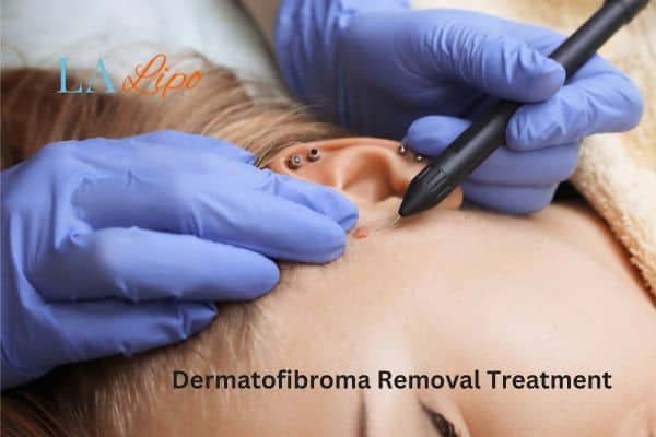Dermatofibroma Removal Treatment Lowestoft