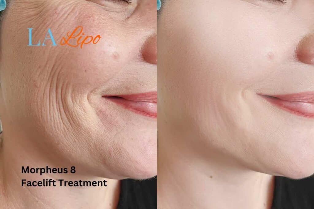 Morpheus8 Treatment Lowestoft for flawless skin! Call us today!
