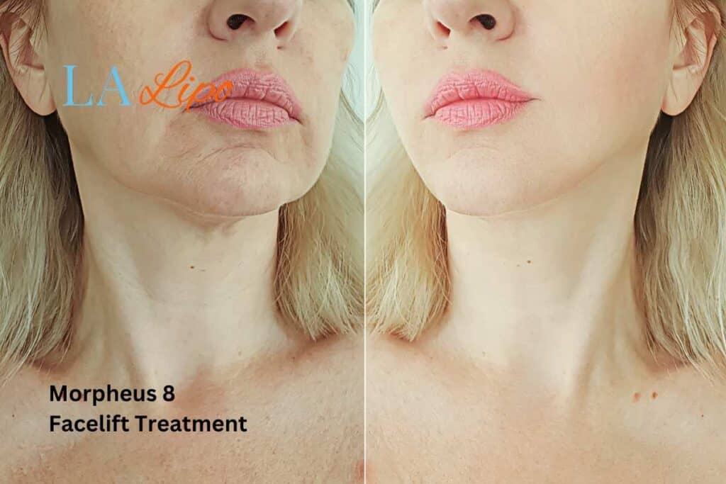 Turn back time with Morpheus8 Treatment Lowestoft