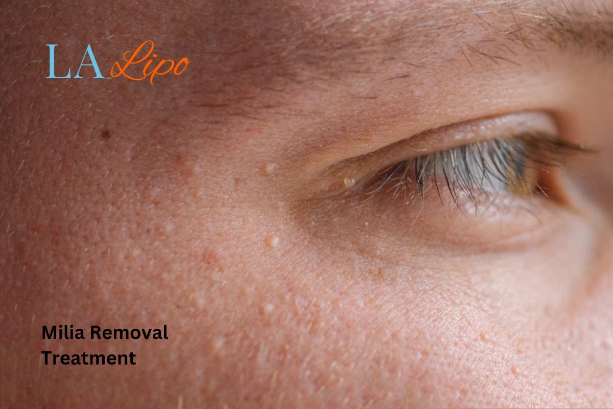 Cryopen Milia Removal: Is It the Easiest and Safest Option Lowestoft?