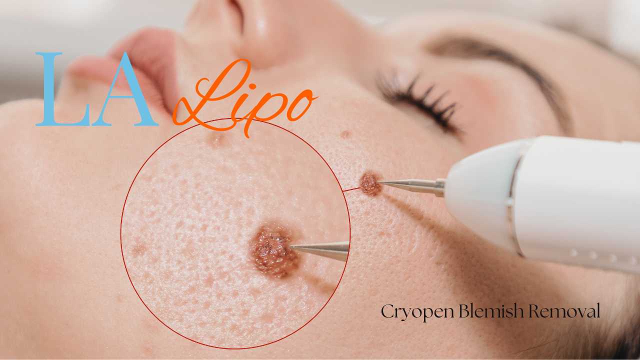 cryopen blemish removal Lowestoft Contact our team today!