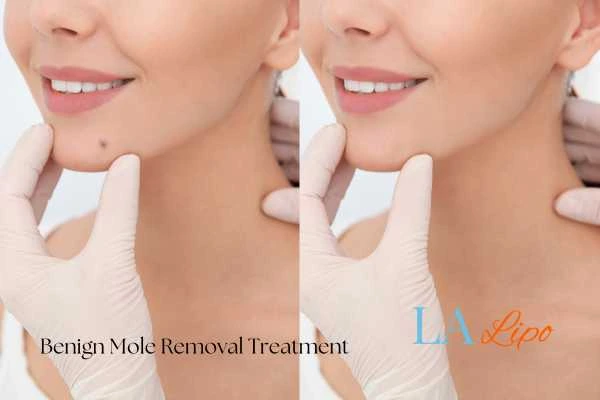 Before-and-after results following benign mole-removal treatment Lowestoft