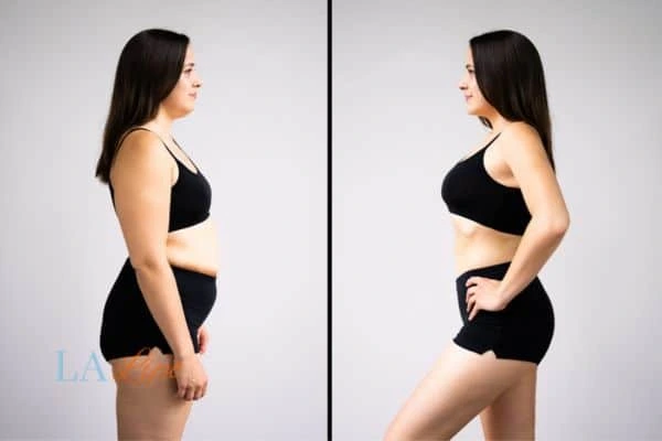 image of woman before and after results of LA-EMS Body Sculpting Lowestoft to help treat Diastasis recti