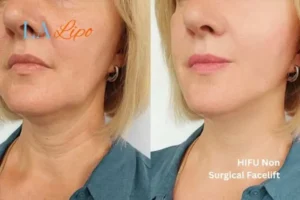 hi-fu for wrinkles Lowestoft before and after results
