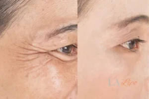 Before and after results of woman - HI-fu wrinkles reduction treatment Lowestoft