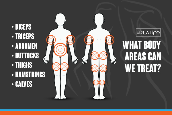 Graphic to show areas you can have LA-EMS Body Sculpting Lowestoft treatment.