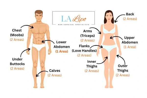 LA LIPO Cryolipolysis Areas Lowestoft