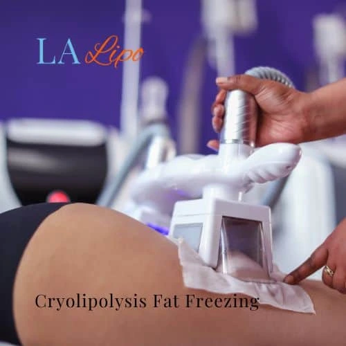 fat freezing - Cryolipolysis Lowestoft