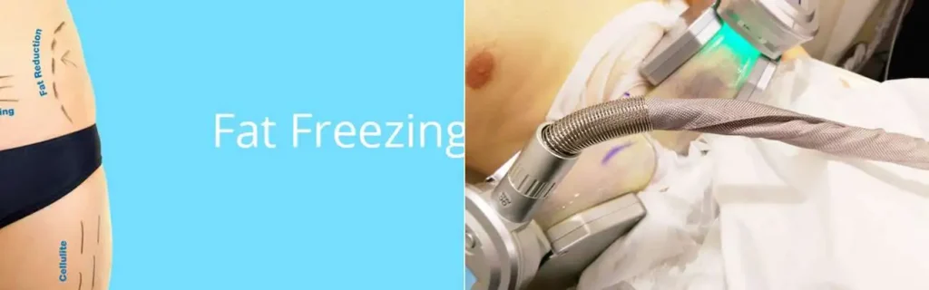 Fat freezing Lowestoft on multiple areas of the body