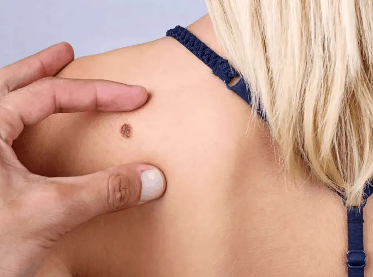 woman having mole removal Lowestoft consultation before treatment.