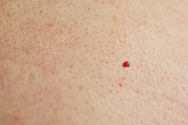close up of a cherry angioma Lowestoft