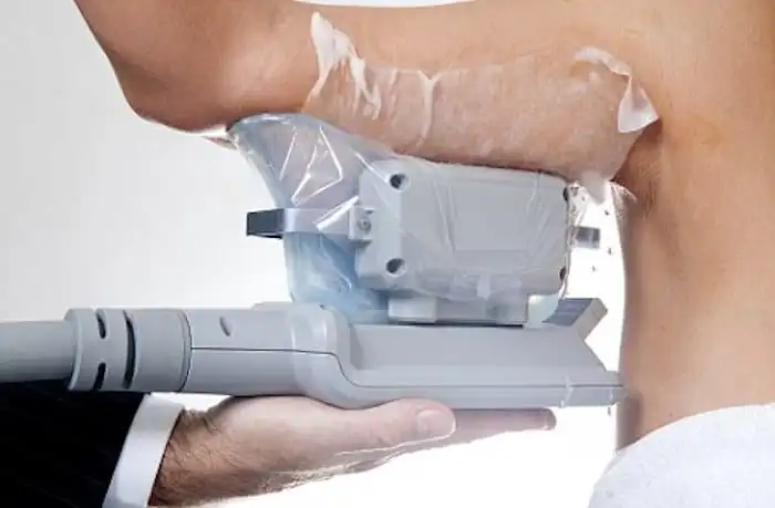 Picture of fat freezing Lowestoft on the upper arms.