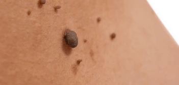 image of a skin tag Lowestoft