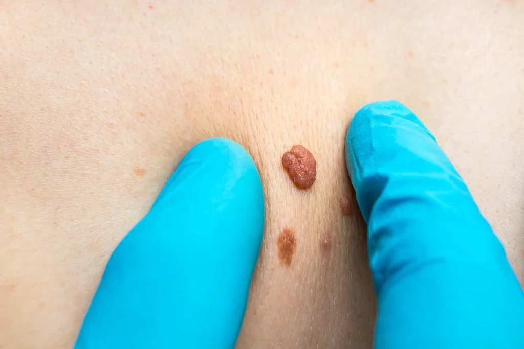 Consultant examining a skin tag Lowestoft