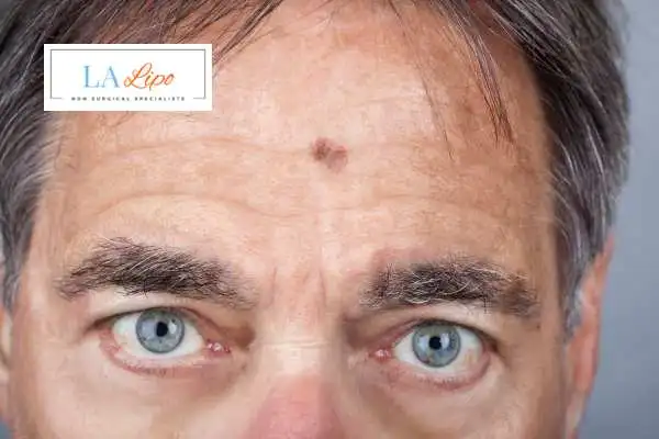 Solar Lentigo Removal Lowestoft image of man with mark on his forehead