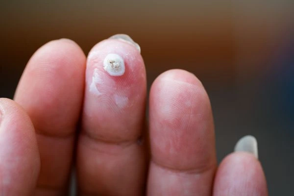 wart on person finger - cryotherapy to treat from LA LIPO Lowestoft