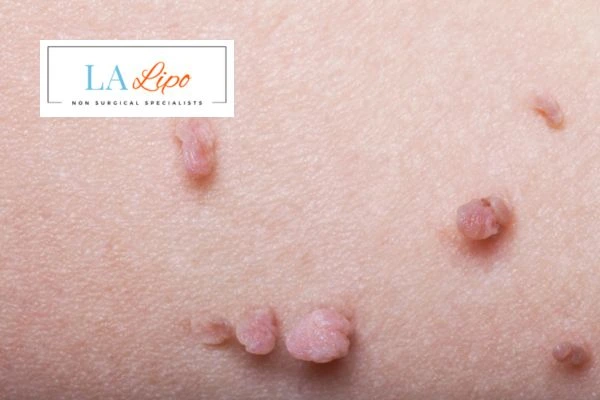 Does cryopen skin tag removal Lowestoft hurt? Find out now call our team today!
