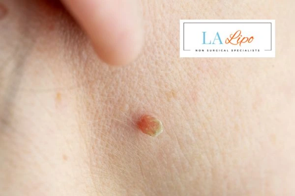 Book skin tag removal Lowestoft today speak to our team now!