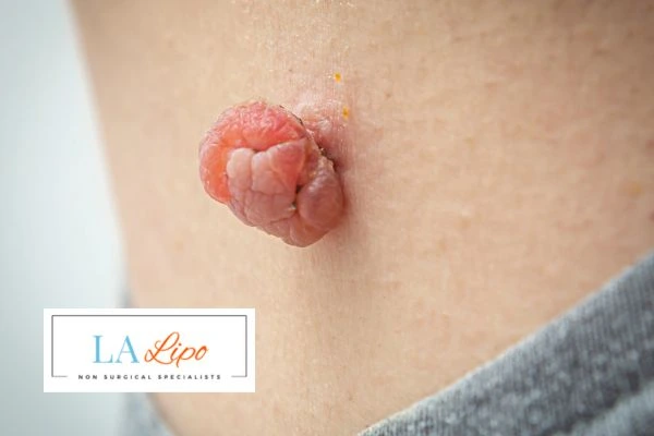 Interested in skin tag removal Lowestoft? Concerned about the pain? Find out more today!