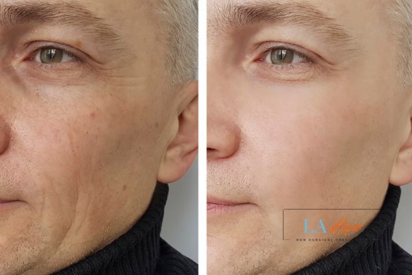 See the amazing results of Morpheus8 Treatment Lowestoft!