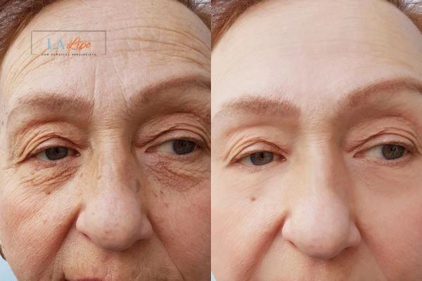 The powerful benefits of Morpheus8 Treatment Lowestoft - Call Our team today!