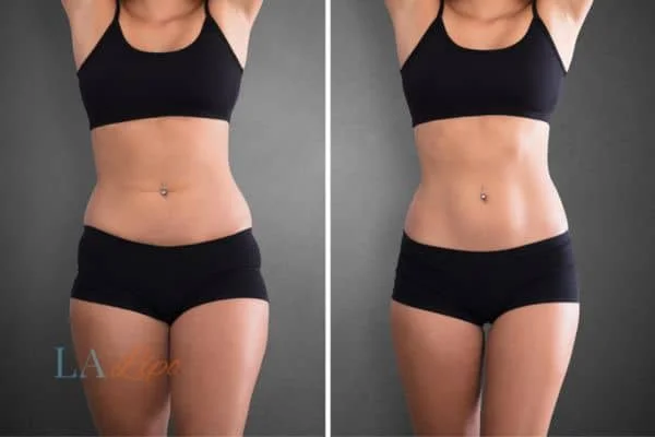 before and after results of non-surgical treatment to help a woman's body image and mental health Lowestoft