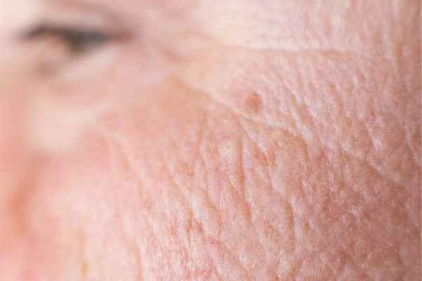 close up picture of a woman's face showing an age spot Lowestoft