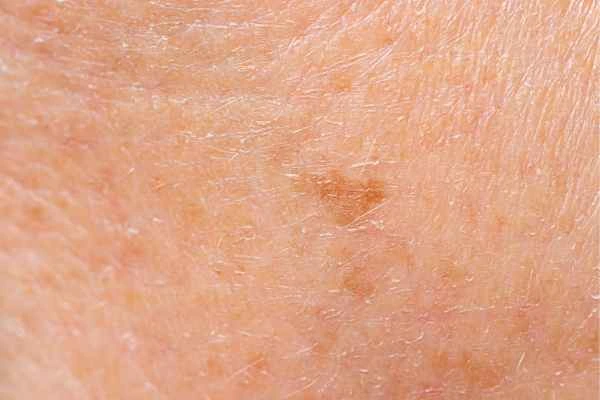 close up picture of age spots Lowestoft
