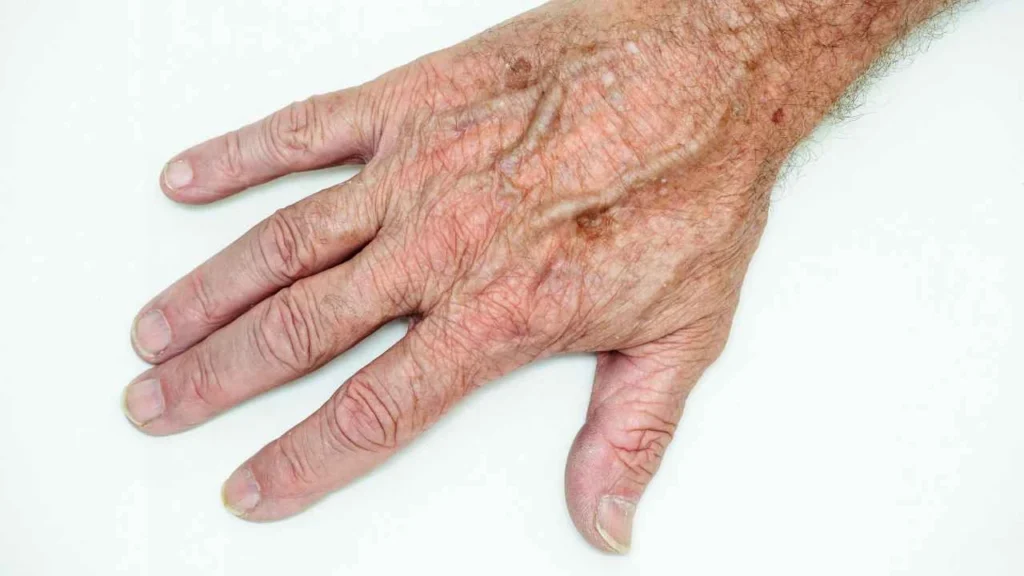 Male hand showing age spot Lowestoft