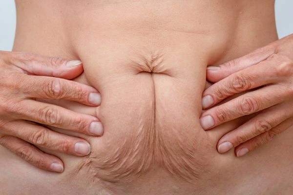 Should I Combine Diastasis Recti Treatment with Body Contouring for Better Results Lowestoft?
