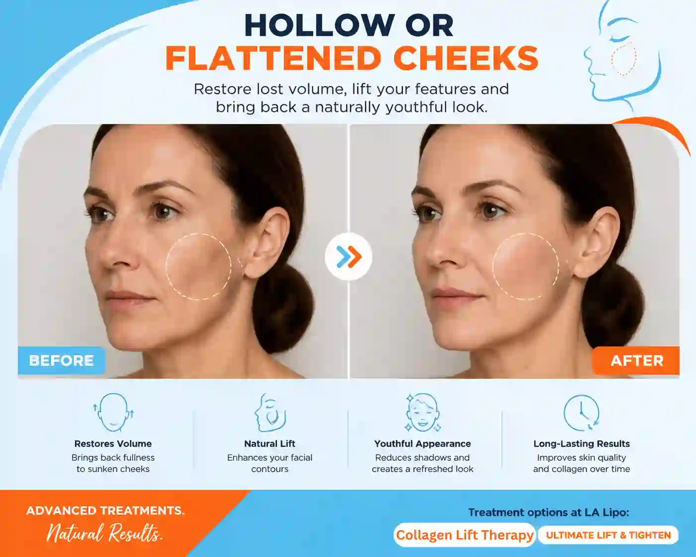 Sign #4: Hollow or Flattened Cheeks Lowestoft