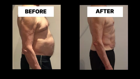 What Symptoms Can Diastasis Recti Cause in Men? Weak Core, Back Pain and Poor Posture Lowestoft